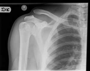 Acromoclavicular joint disruption