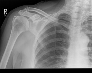 Acromoclavicular joint osteoarthritis