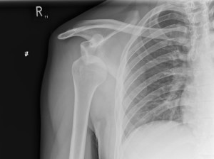 Anterior Shoulder Dislocation