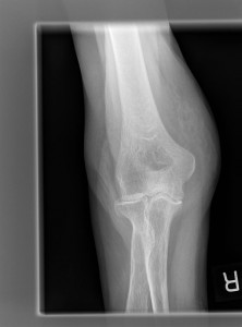 Elbow osteoarthritis