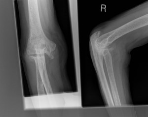 Elbow rheumatoid arthritis