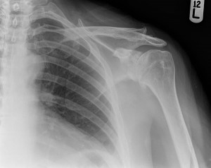 Osteoarthritis of the glenohumeral Joint
