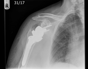 Reverse shoulder replacement