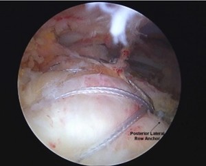 Rotator Cuff Repaired