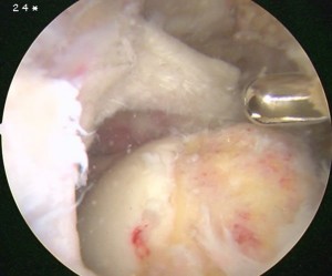 Rotator Cuff Tear